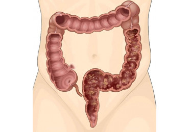 What is colitis?