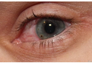 Conjunctivitis - how to treat, symptoms and signs, causes and types