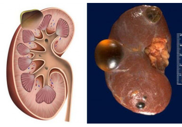 What types of cysts are there and how to treat them