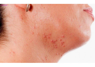 How to treat herpes at home?