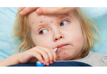Measles - Symptoms and Treatment