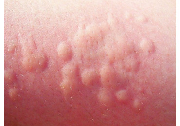 The most effective folk remedies for the treatment of urticaria in adults