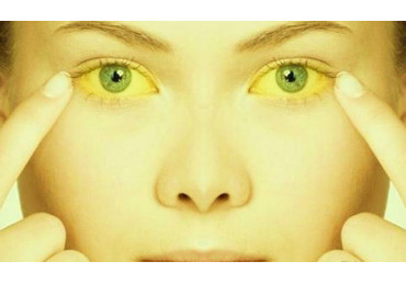 Jaundice: causes, symptoms and treatment in children and adults