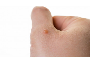 Types of warts, causes and methods of treatment